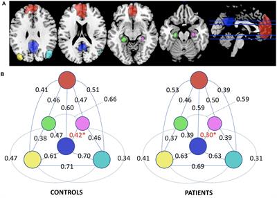 Default Mode Network Complexity and Cognitive Decline in Mild Alzheimer’s Disease